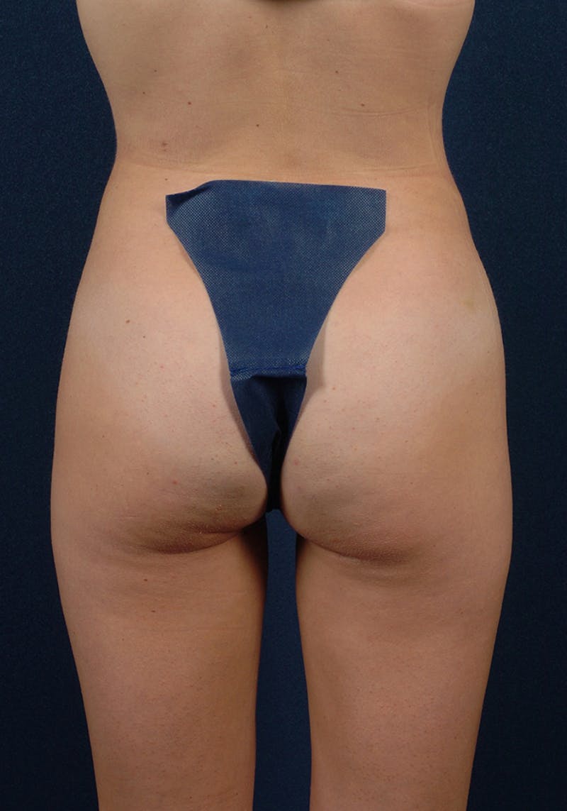 Female Liposuction Before & After Gallery - Patient 9421750 - Image 6