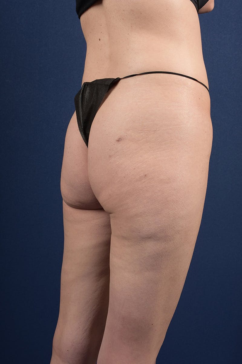 Gluteal Augmentation Before & After Gallery - Patient 9421752 - Image 3