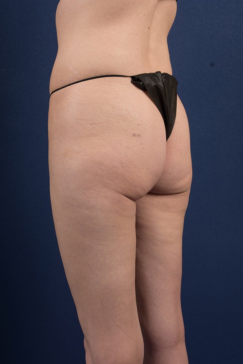 Gluteal Augmentation Before & After Gallery - Patient 9421752 - Image 5