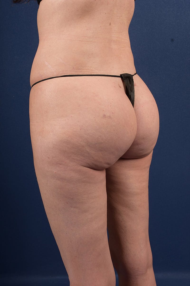 Gluteal Augmentation Before & After Gallery - Patient 9421752 - Image 6