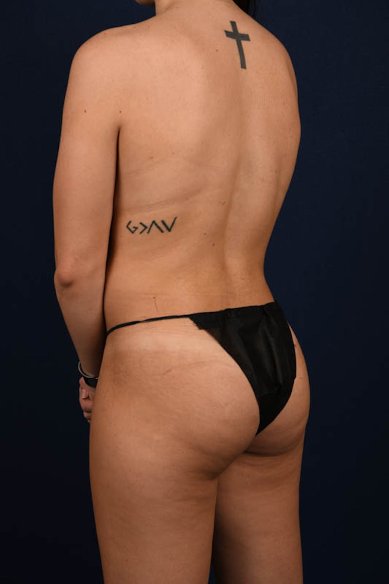 Female Liposuction Before & After Gallery - Patient 9421753 - Image 6