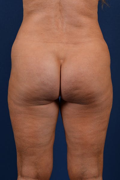 Gluteal Augmentation Before & After Gallery - Patient 9421755 - Image 1