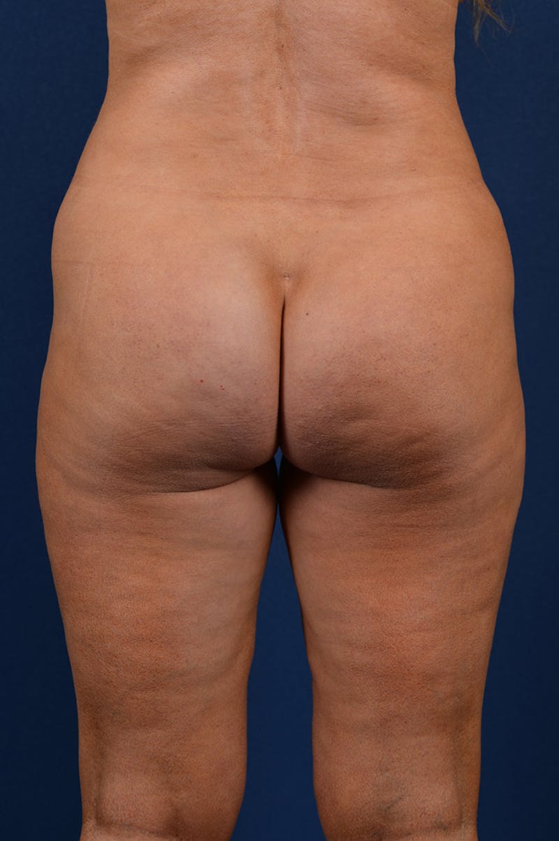 Gluteal Augmentation Before & After Gallery - Patient 9421755 - Image 1