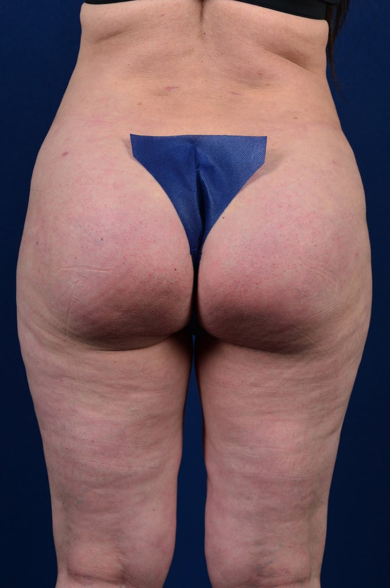 Gluteal Augmentation Before & After Gallery - Patient 9421755 - Image 2
