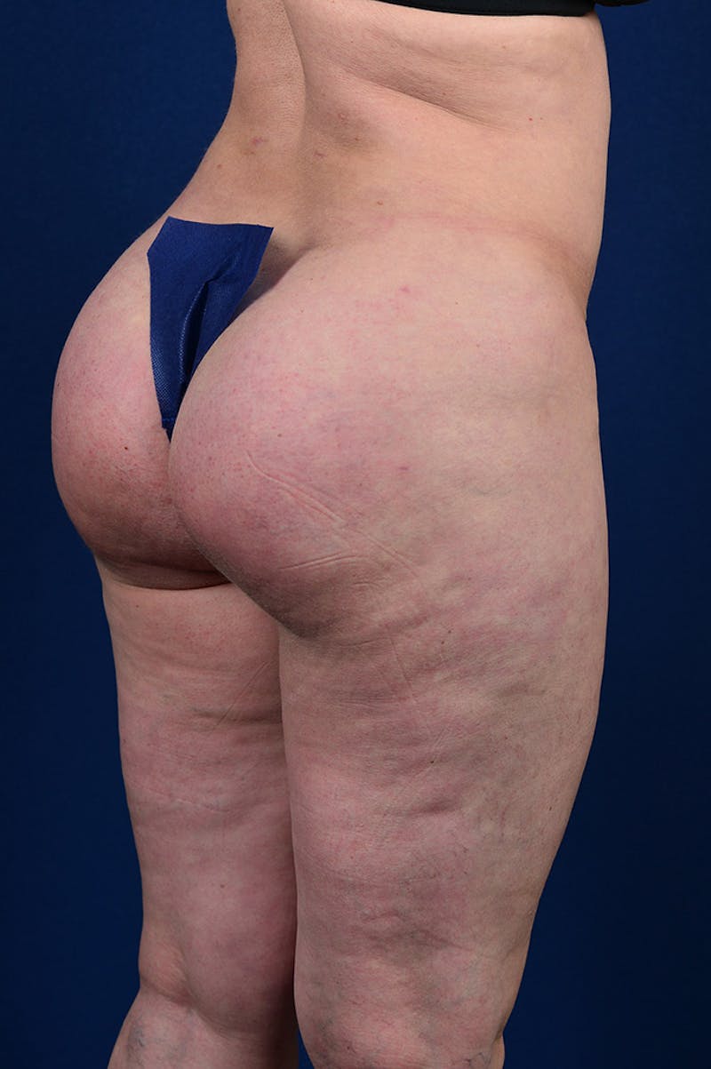 Gluteal Augmentation Before & After Gallery - Patient 9421755 - Image 4