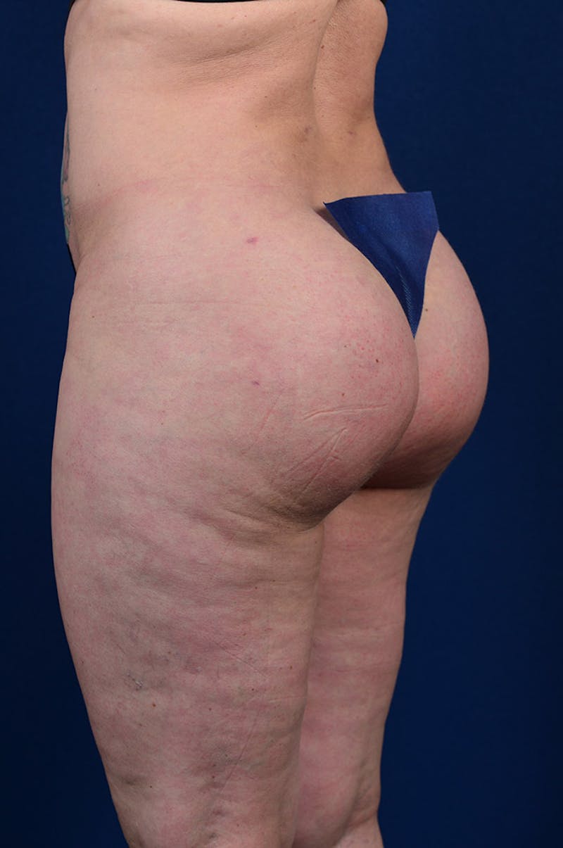 Gluteal Augmentation Before & After Gallery - Patient 9421755 - Image 6