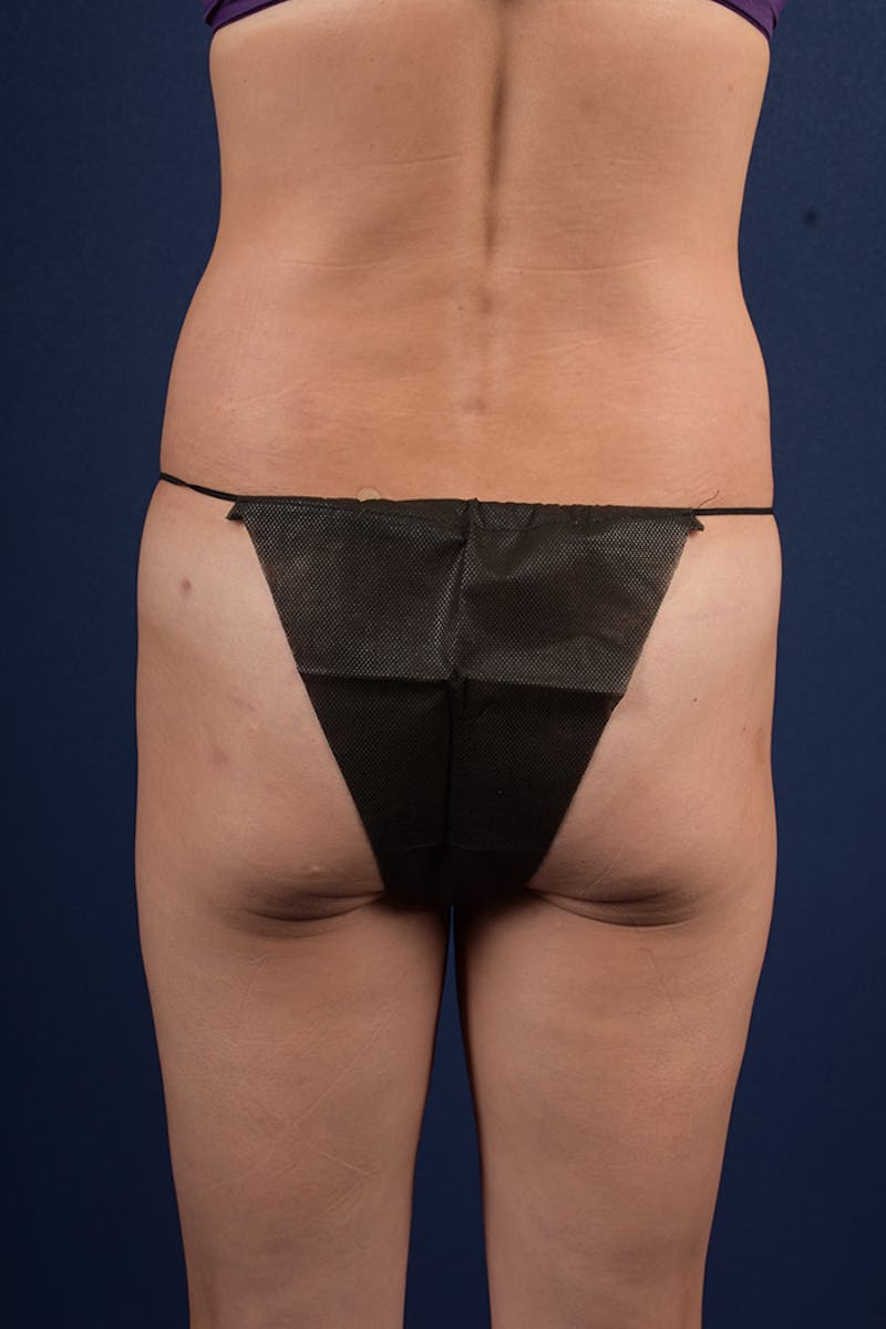 Gluteal Augmentation Before & After Gallery - Patient 9421758 - Image 1