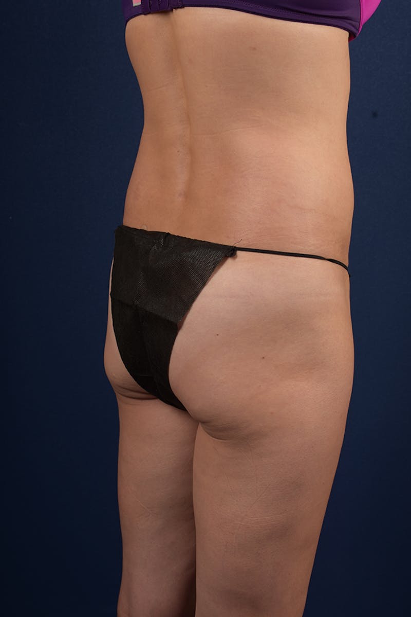 Gluteal Augmentation Before & After Gallery - Patient 9421758 - Image 3