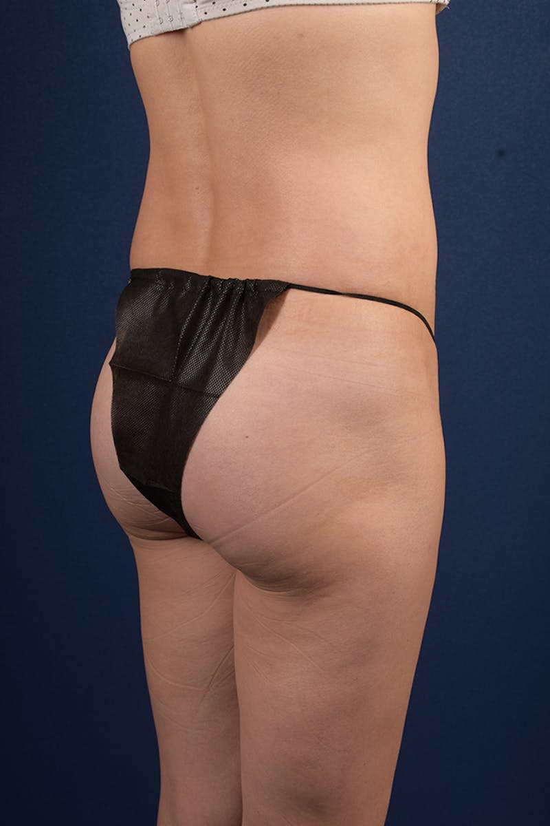 Gluteal Augmentation Before & After Gallery - Patient 9421758 - Image 4