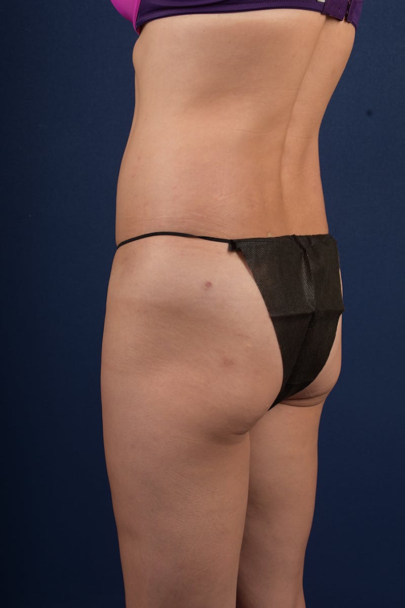 Gluteal Augmentation Before & After Gallery - Patient 9421758 - Image 5