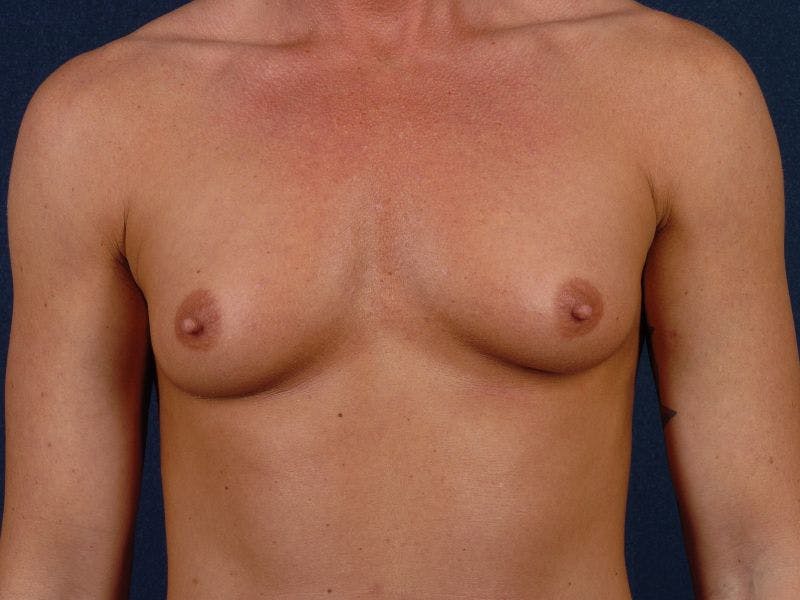 Large Augmentation Before & After Gallery - Patient 9421911 - Image 1