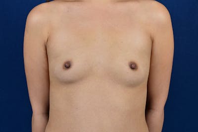 Medium Augmentation Before & After Gallery - Patient 883172 - Image 1