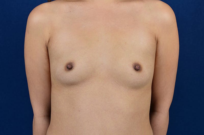 Medium Augmentation Before & After Gallery - Patient 9421913 - Image 1