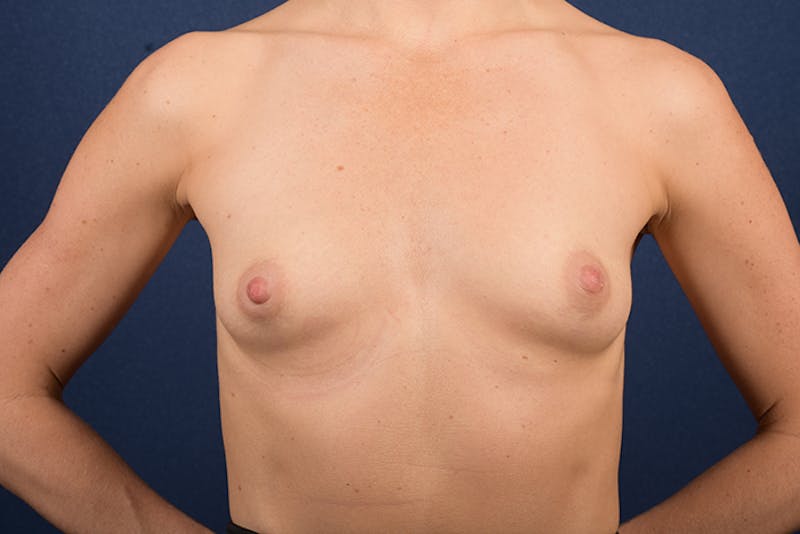 Small Augmentation Before & After Gallery - Patient 9421916 - Image 1