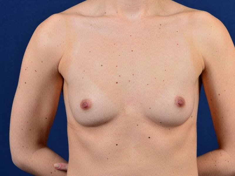 Medium Augmentation Before & After Gallery - Patient 9421915 - Image 1