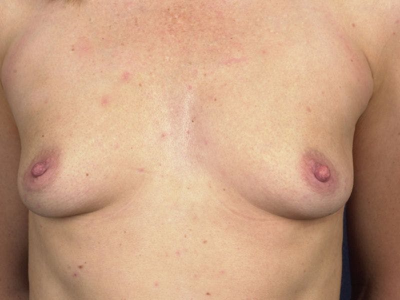 Medium Augmentation Before & After Gallery - Patient 9421919 - Image 1