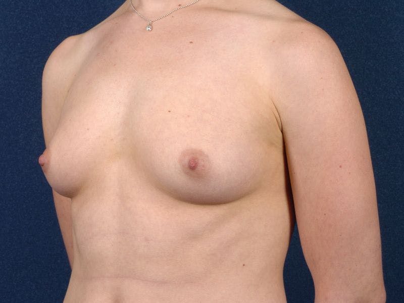 Large Augmentation Before & After Gallery - Patient 9421918 - Image 3