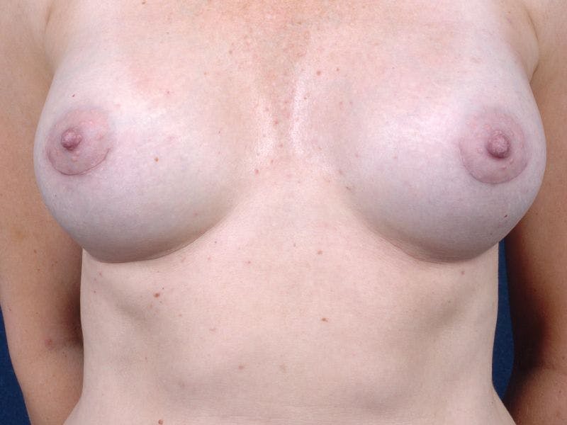 Medium Augmentation Before & After Gallery - Patient 9421919 - Image 2