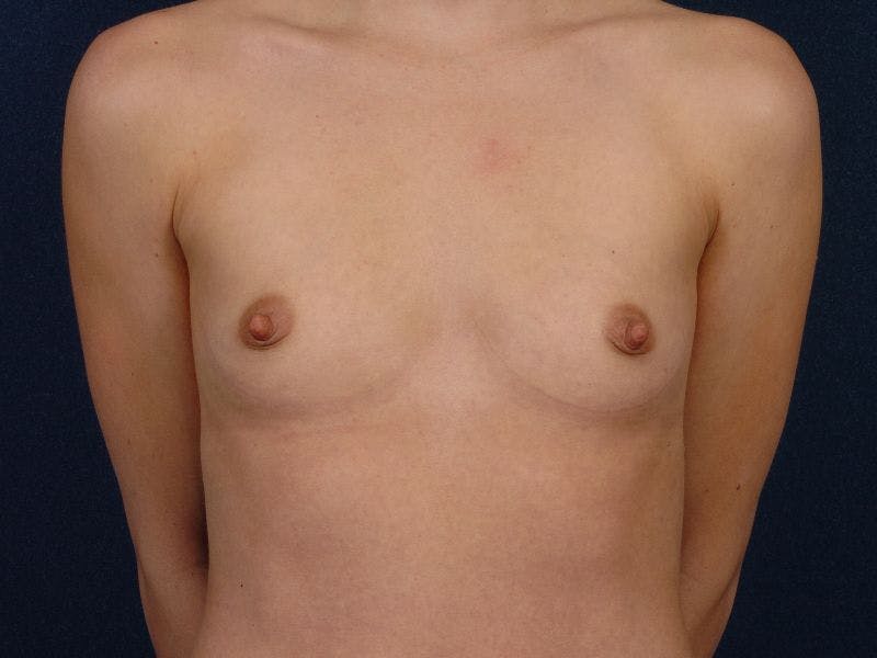Small Augmentation Before & After Gallery - Patient 9421921 - Image 1