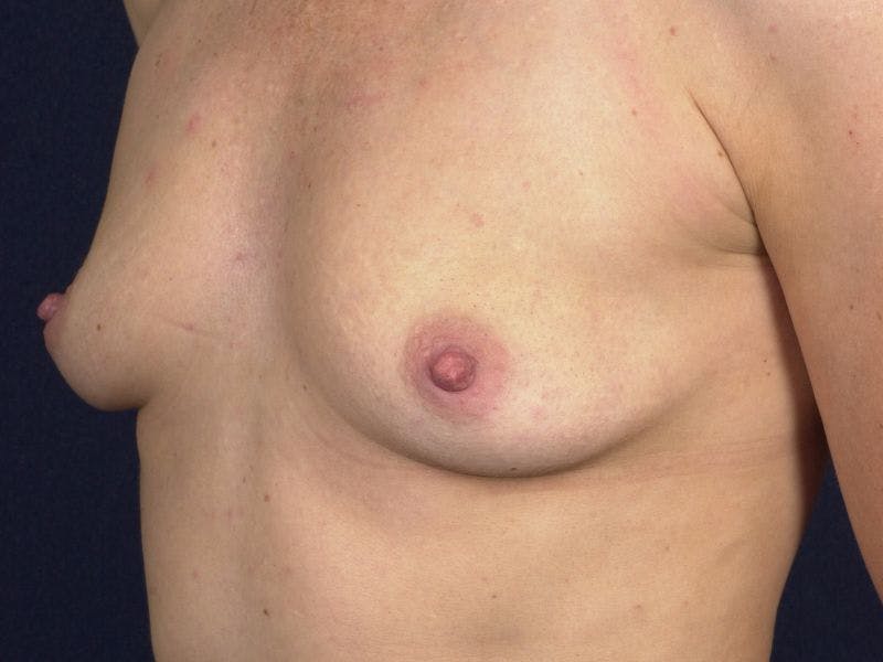 Medium Augmentation Before & After Gallery - Patient 9421919 - Image 3