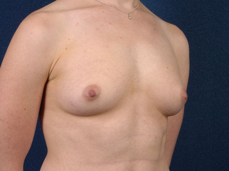 Large Augmentation Before & After Gallery - Patient 9421918 - Image 5