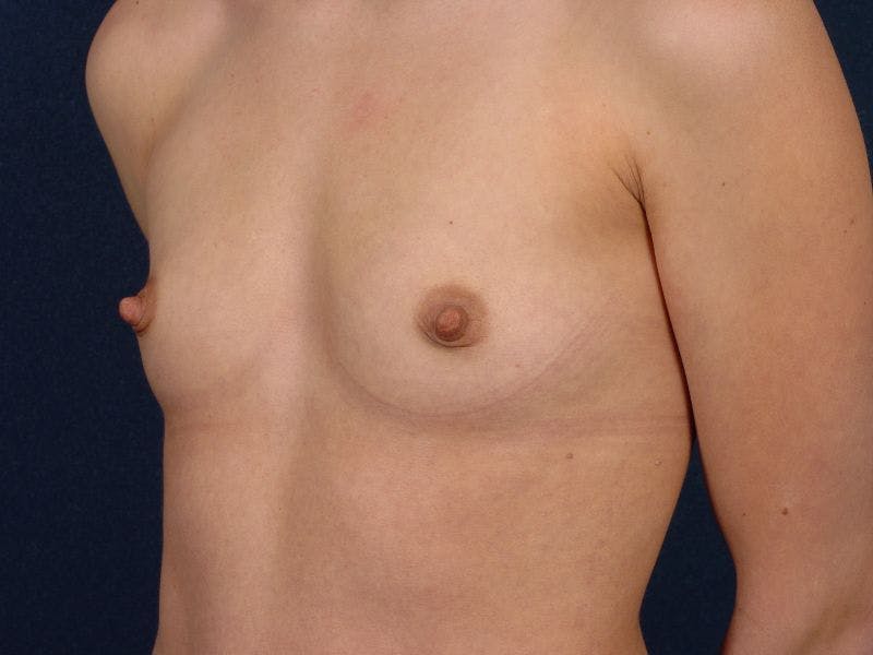 Small Augmentation Before & After Gallery - Patient 9421921 - Image 3