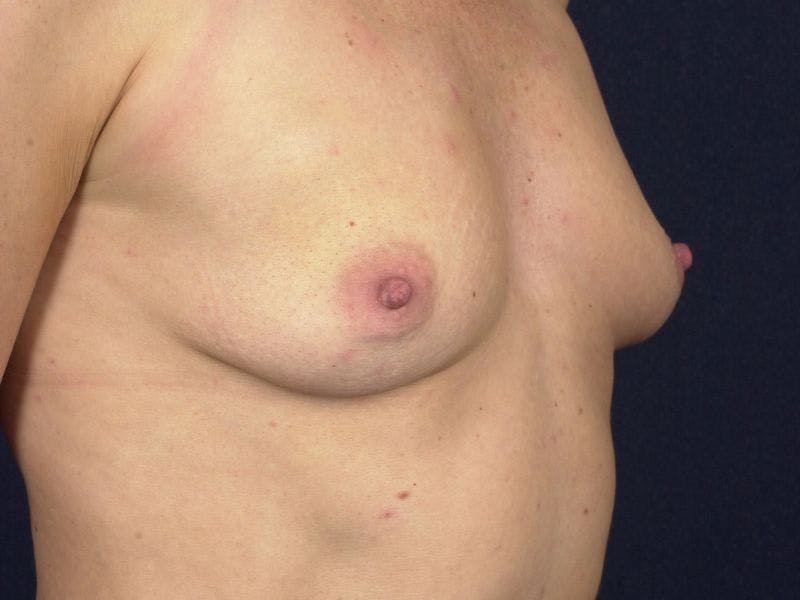 Medium Augmentation Before & After Gallery - Patient 9421919 - Image 5