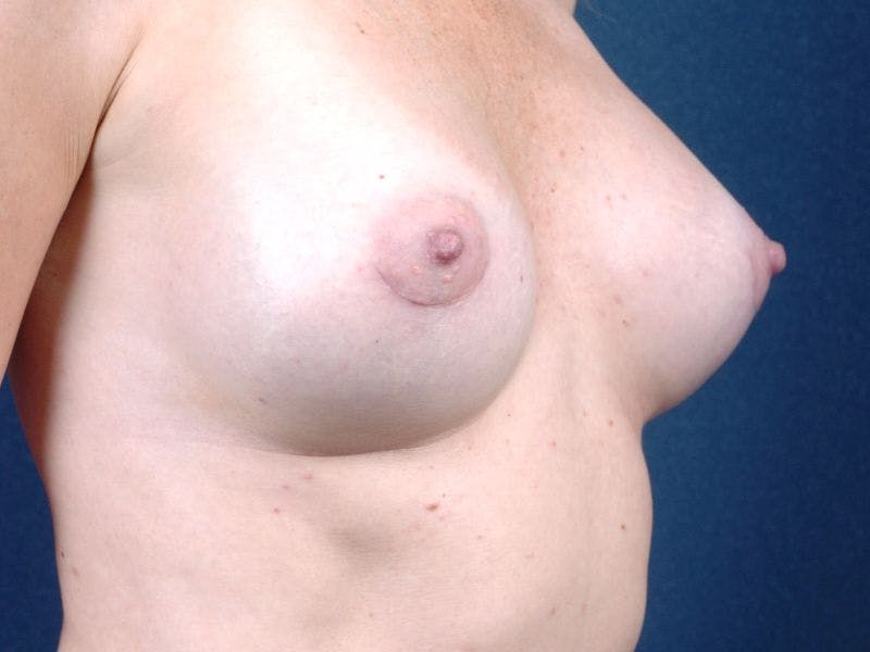 Medium Augmentation Before & After Gallery - Patient 9421919 - Image 6