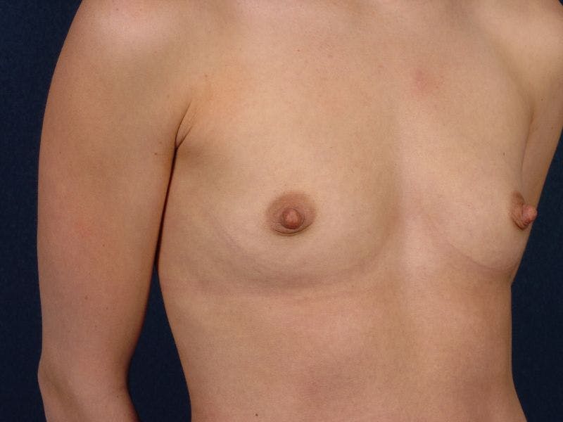 Small Augmentation Before & After Gallery - Patient 9421921 - Image 5
