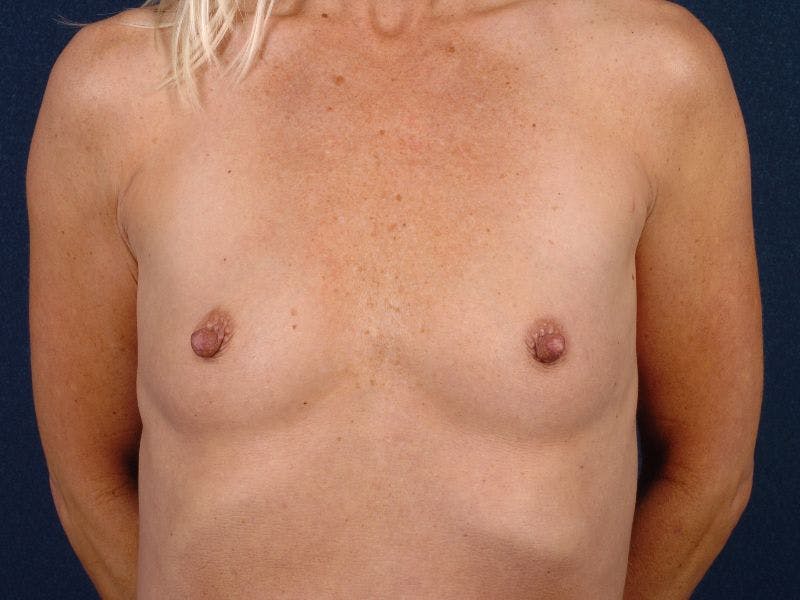 Small Augmentation Gallery - Patient 9421925 - Image 1