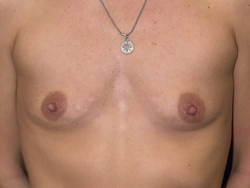 Saline Augmentation Before & After Gallery - Patient 9421927 - Image 1