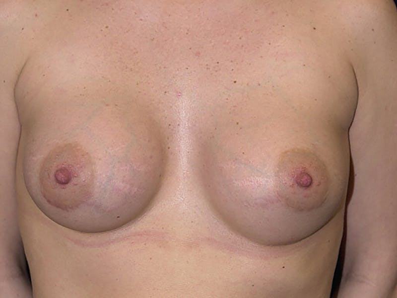 Saline Augmentation Before & After Gallery - Patient 9421927 - Image 2
