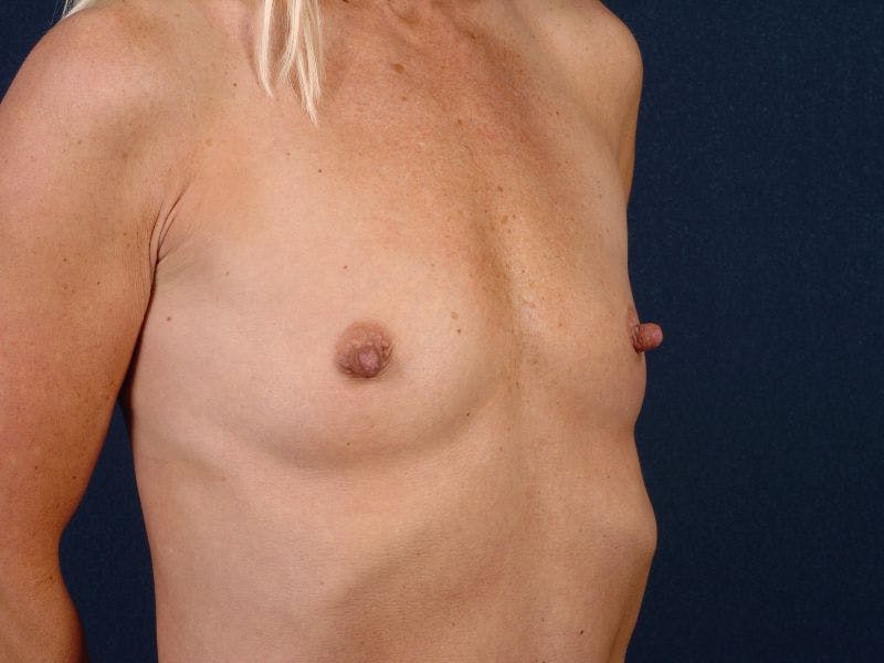 Small Augmentation Before & After Gallery - Patient 9421925 - Image 5