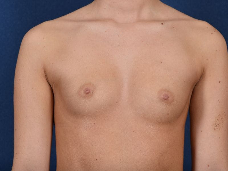 Complex Augmentation Before & After Gallery - Patient 9421928 - Image 1