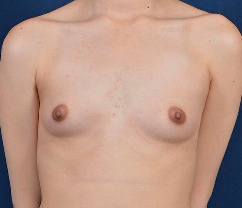 Small Augmentation Before & After Gallery - Patient 9421930 - Image 1