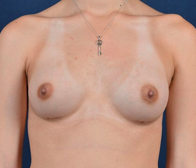 Small Augmentation Before & After Gallery - Patient 9421930 - Image 2