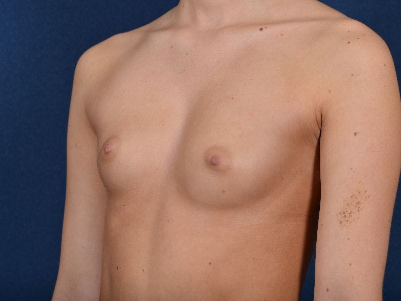 Complex Augmentation Before & After Gallery - Patient 9421928 - Image 3
