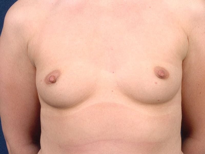 Saline Augmentation Before & After Gallery - Patient 9421932 - Image 1