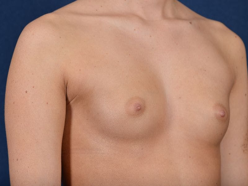 Complex Augmentation Before & After Gallery - Patient 9421928 - Image 5