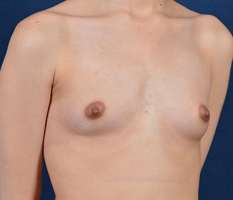 Small Augmentation Before & After Gallery - Patient 9421930 - Image 5