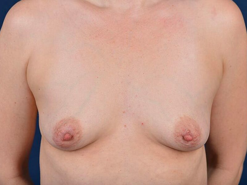 Medium Augmentation Before & After Gallery - Patient 9421935 - Image 1