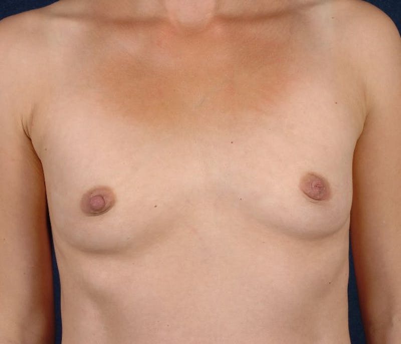 Small Augmentation Before & After Gallery - Patient 9421936 - Image 1