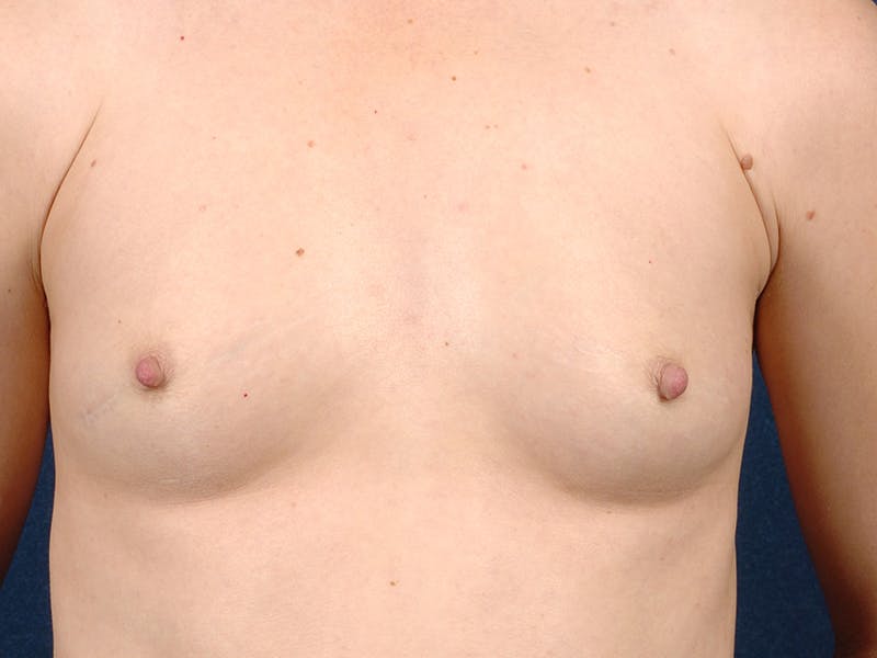 Saline Augmentation Before & After Gallery - Patient 9421939 - Image 1
