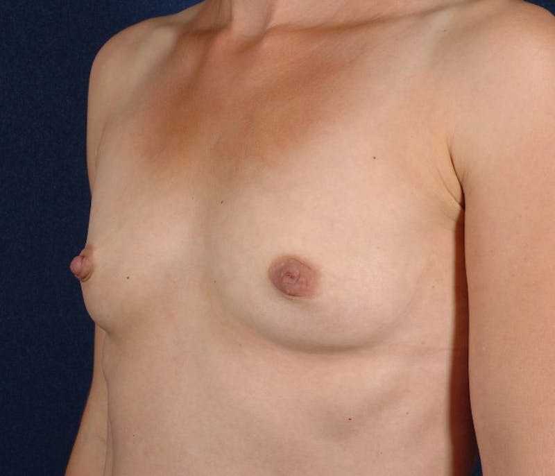 Small Augmentation Before & After Gallery - Patient 9421936 - Image 3