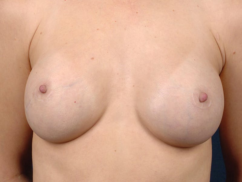 Saline Augmentation Before & After Gallery - Patient 9421939 - Image 2