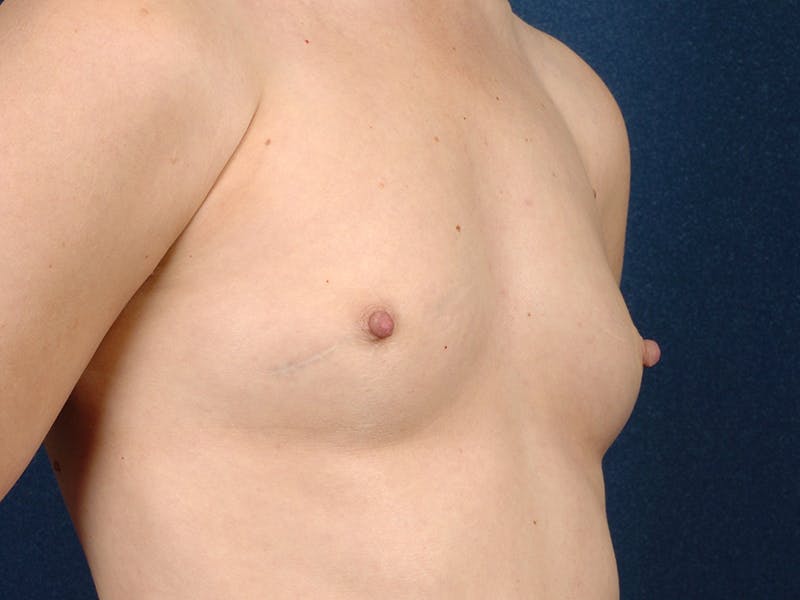 Saline Augmentation Before & After Gallery - Patient 9421939 - Image 3