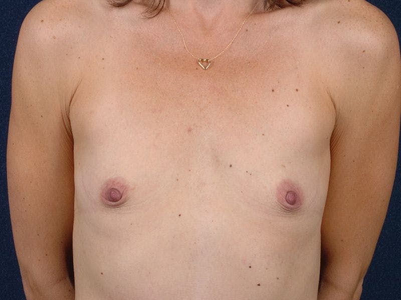 Medium Augmentation Before & After Gallery - Patient 9421942 - Image 1