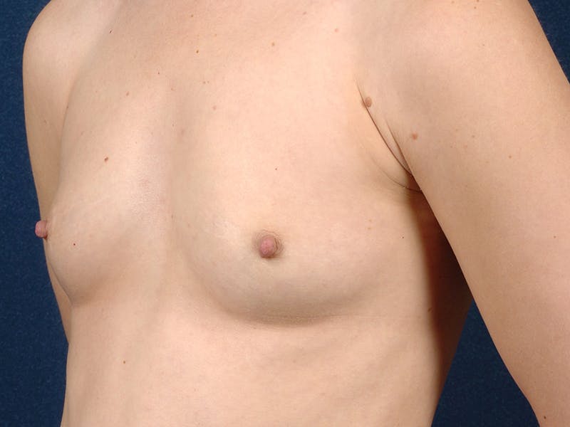 Saline Augmentation Before & After Gallery - Patient 9421939 - Image 5
