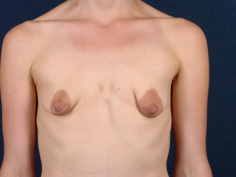 Tuberous Breast Augmentation Before & After Gallery - Patient 9421947 - Image 1