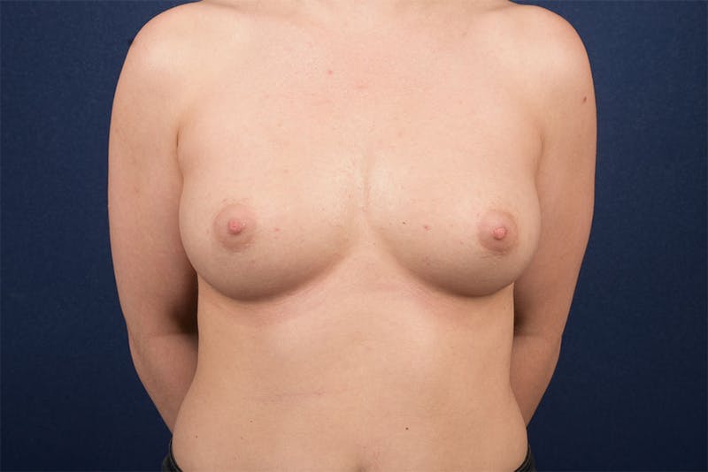 Large Augmentation Before & After Gallery - Patient 9421949 - Image 1